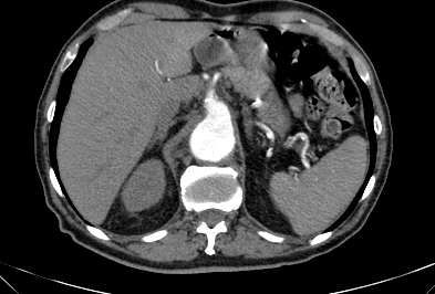 Anterior vertebral scalloping (abdominal aortic aneurysm) (Radiopaedia 66744-76067 F 8).jpg