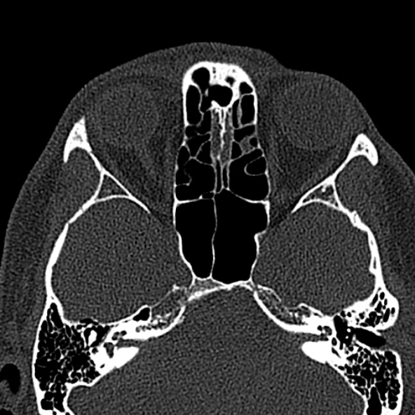 Antrochoanal polyp (Radiopaedia 30002-30554 Axial bone window 40).jpg