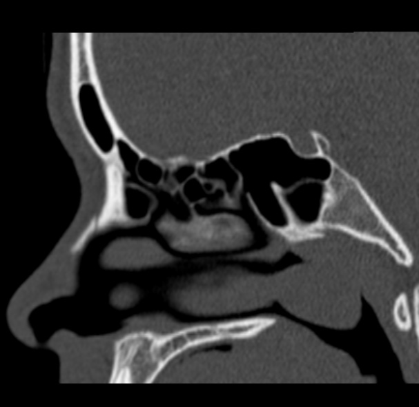 Antrochoanal polyp (Radiopaedia 33984-35202 Sagittal bone window 45).jpg