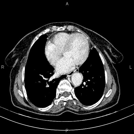 Aortic aneurysm and Lemmel syndrome (Radiopaedia 86499-102554 A 4).jpg