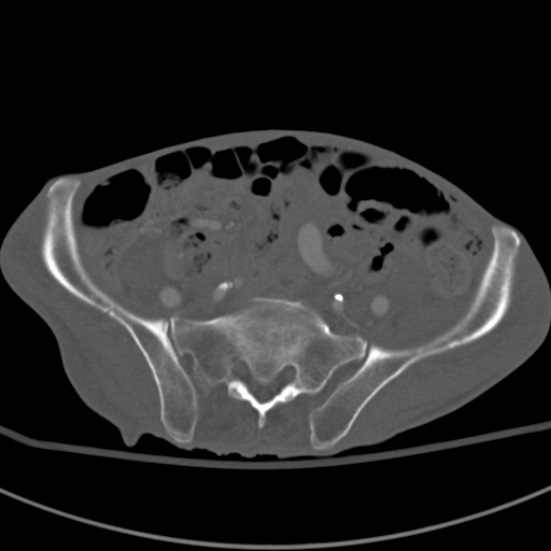 Aortic aneurysm with spinal destruction (Radiopaedia 42301-45410 Axial bone window 80).jpg