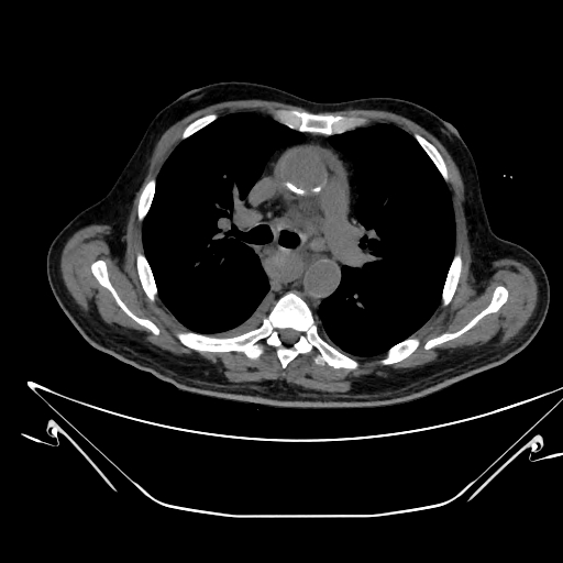 Aortic arch aneurysm (Radiopaedia 84109-99365 Axial non-contrast 116).jpg