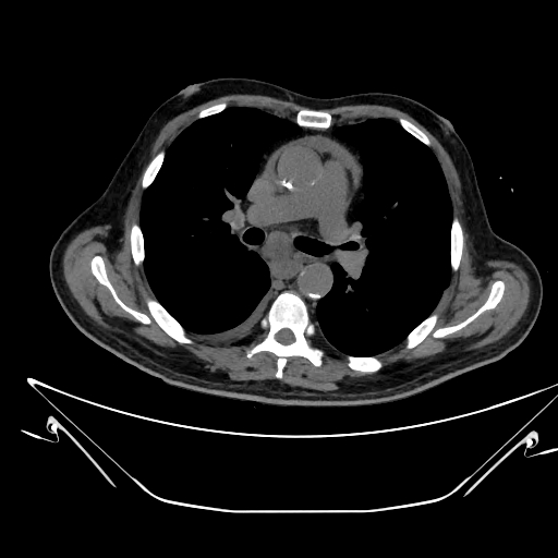 Aortic arch aneurysm (Radiopaedia 84109-99365 Axial non-contrast 126).jpg