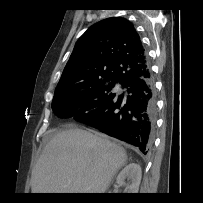 Aortic arch graft infection (FDG PET-CT) (Radiopaedia 71975-82437 C 19).jpg