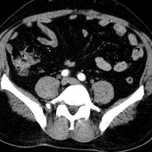 File:Aortic dissection- DeBakey type 1 - Stanford type A (Radiopaedia 40744).JPEG