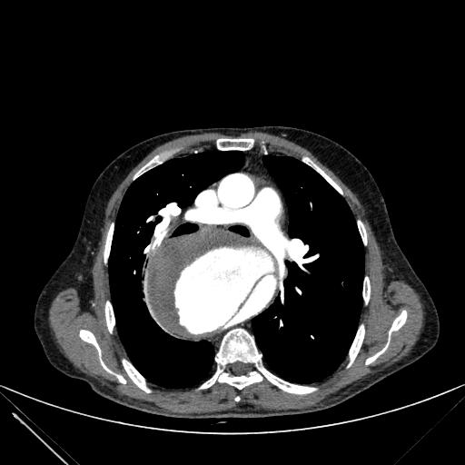 Aortic dissection (Radiopaedia 27466-27665 C+ arterial phase 104).jpg