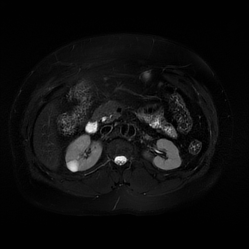 File:Aortic dissection (Radiopaedia 57969-64956 Axial T2 fat sat 30).jpg