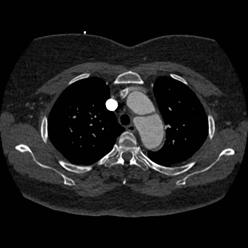 Aortic dissection (Radiopaedia 57969-64959 A 91).jpg
