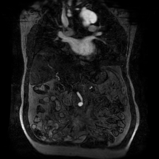 Aortic dissection - Stanford A - DeBakey I (Radiopaedia 23469-23551 D 105).jpg