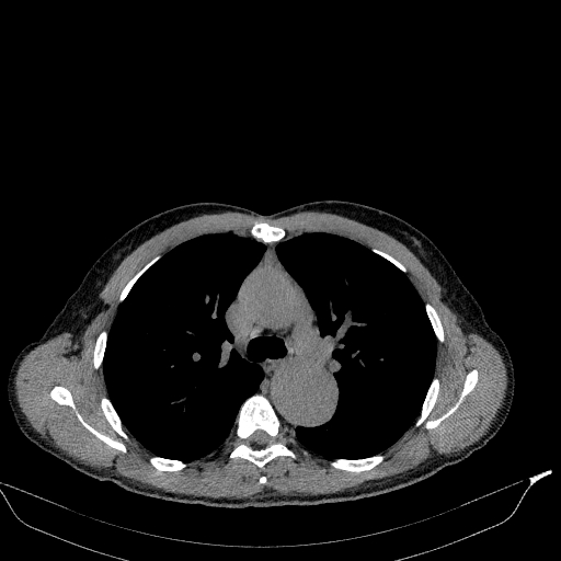Aortic dissection - Stanford type A (Radiopaedia 83418-98500 Axial non-contrast 16).jpg