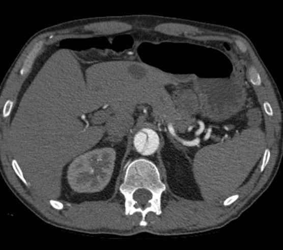 Aortic dissection - Stanford type B (Radiopaedia 73648-84437 A 121).jpg