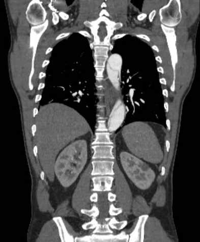 File:Aortic dissection - Stanford type B (Radiopaedia 73648-84437 B 83).jpg