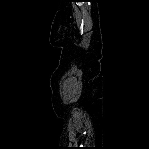 Aortic dissection - Stanford type B (Radiopaedia 88281-104910 C 83).jpg