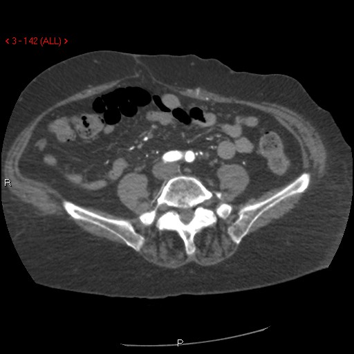 Aortic intramural hematoma (Radiopaedia 27746-28001 A 142).jpg