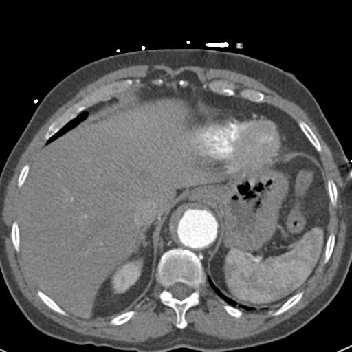 Aortic intramural hematoma (Radiopaedia 31139-31838 B 75).jpg