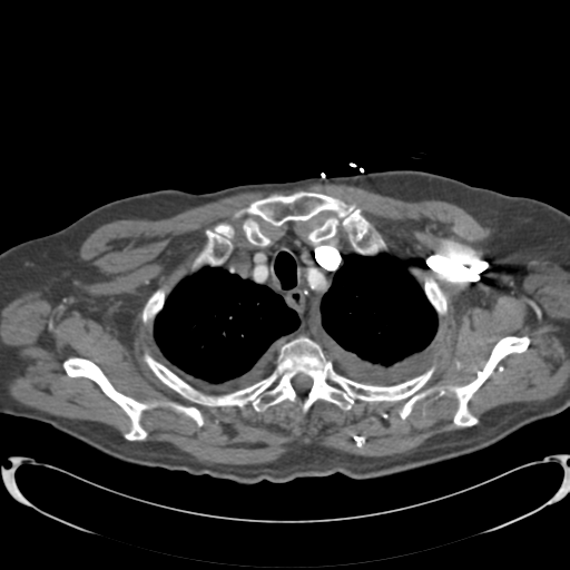 Aortic intramural hematoma (Radiopaedia 34260-35540 B 3).png