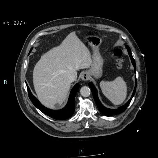 Aortic intramural hematoma (Radiopaedia 48463-53380 C 133).jpg