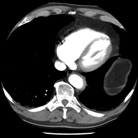 Aortic intramural hematoma (type B) (Radiopaedia 79323-92387 B 42).jpg