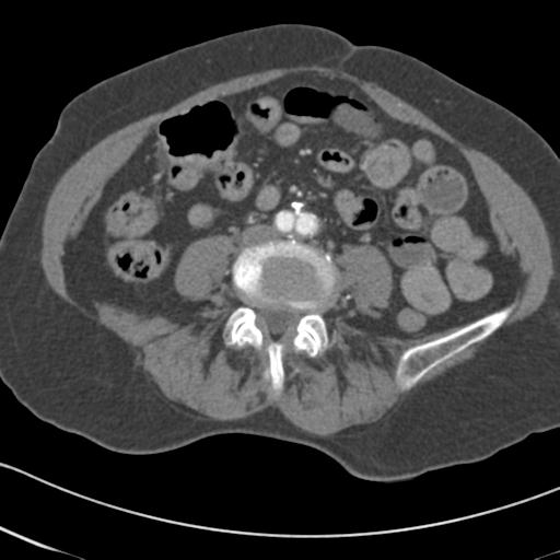 Aortic intramural hematoma from penetrating atherosclerotic ulcer (Radiopaedia 31137-31836 A 125).jpg
