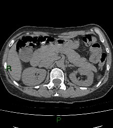 File:Aortic valve endocarditis (Radiopaedia 87209-103485 Axial non-contrast 104).jpg