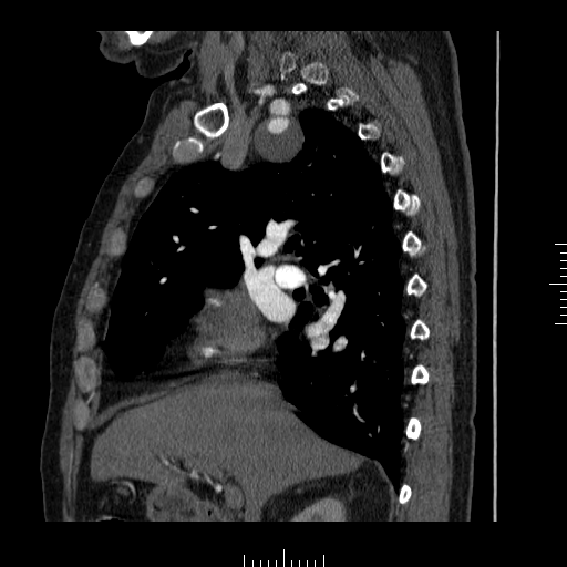 File:Aorto-coronary bypass graft aneurysms (Radiopaedia 40562-43157 C 9).png