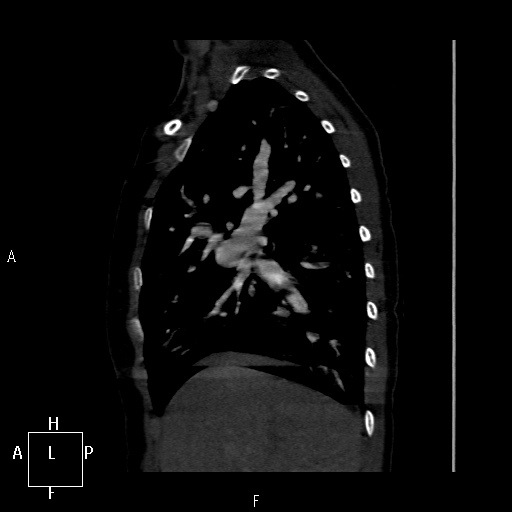 File:Aortopulmonary septal defect (Radiopaedia 41990-45013 Sagittal C+ CTPA 47).jpg