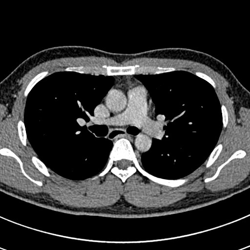 Apical lung mass mimic - neurogenic tumor (Radiopaedia 59918-67521 A 34).jpg