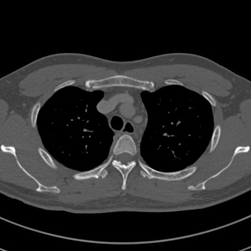 File:Apical lung mass mimic - neurogenic tumor (Radiopaedia 59918-67521 Axial bone window 21).jpg