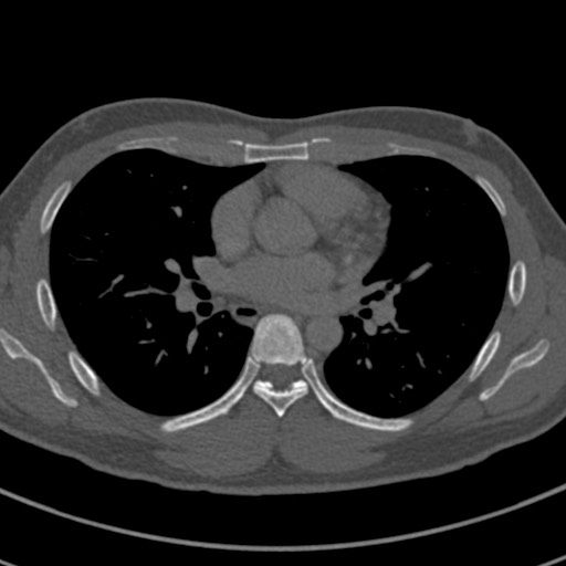 Apical lung mass mimic - neurogenic tumor (Radiopaedia 59918-67521 Axial bone window 42).jpg