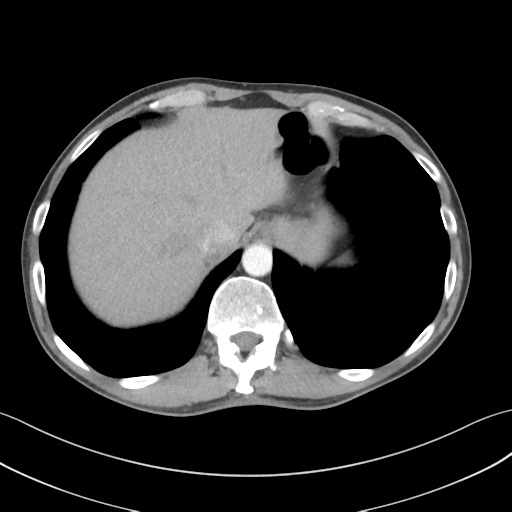 File:Apical pleural calcification (Radiopaedia 46141-50499 Axial C+ delayed 61).png