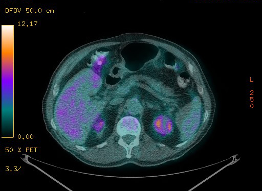 Appendiceal adenocarcinoma complicated by retroperitoneal abscess (Radiopaedia 58007-65041 Axial PET-CT 111).jpg
