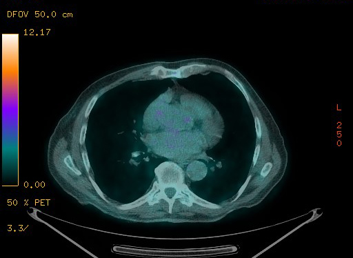 Appendiceal adenocarcinoma complicated by retroperitoneal abscess (Radiopaedia 58007-65041 Axial PET-CT 75).jpg