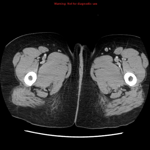 Appendiceal mucinous cystadenoma (Radiopaedia 8263-9111 Axial liver window 92).jpg
