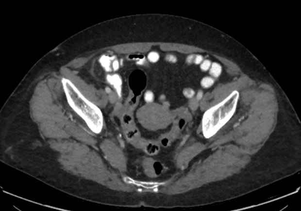 Appendicitis due to chicken fibula (Radiopaedia 74314-85198 A 41).jpg