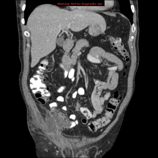 File:Appendicitis mass in inguinal hernia (Radiopaedia 26858-27029 B 22).jpg