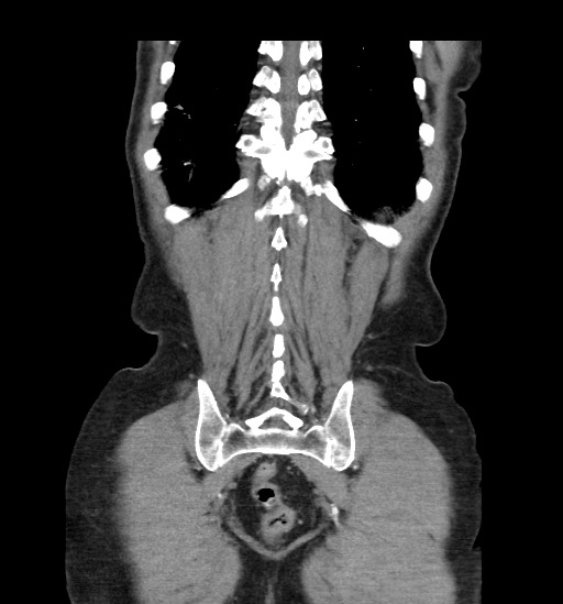 Appendicitis with localized perforation and abscess formation (Radiopaedia 49035-54130 B 43).jpg