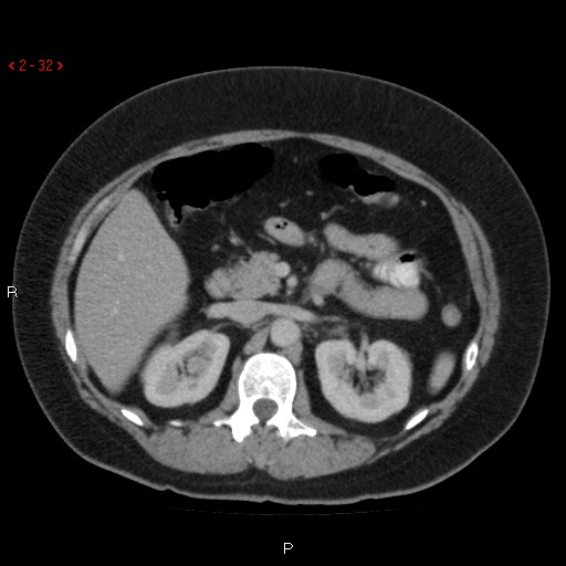 File:Appendicitis with microperforation- promontoric type (Radiopaedia 27268-27442 C 20).jpg