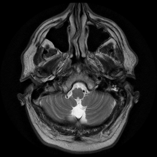 File:Aqueduct stenosis with corpus callosum hypoattenuation post shunting (Radiopaedia 37212-38969 Axial T2 2).png