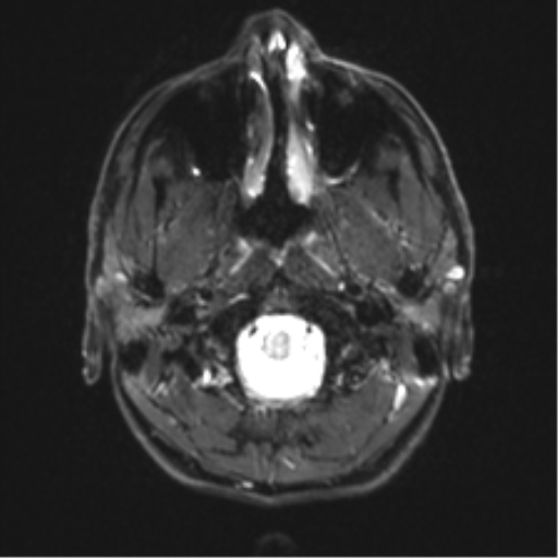 Arachnoid cyst - cerebellopontine angle (Radiopaedia 59689-67083 Axial DWI 2).png