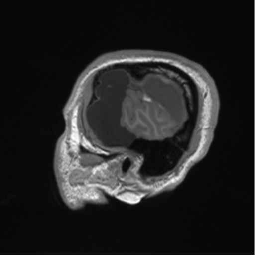 Arachnoid cyst with subdural hematoma (Radiopaedia 85892-101743 Sagittal T1 13).png