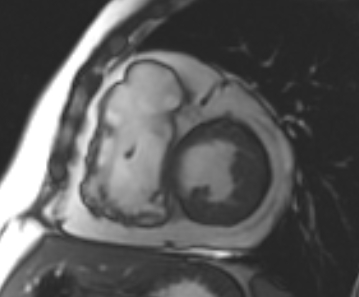 File:Arrhythmogenic right ventricular cardiomyopathy (Radiopaedia 69431-79307 Short axis cine 129).jpg