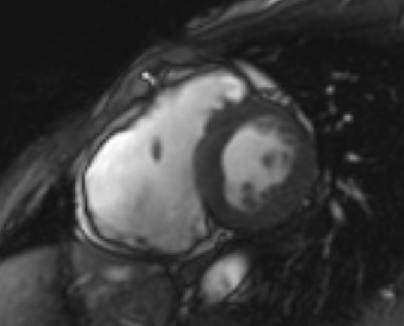 Arrhythmogenic right ventricular cardiomyopathy (Radiopaedia 69564-79464 short axis cine 167).jpg