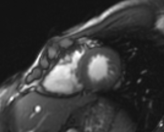 Arrhythmogenic right ventricular cardiomyopathy (Radiopaedia 69564-79464 short axis cine 85).jpg