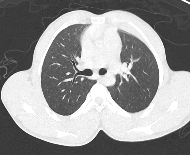 Arrow injury to the chest (Radiopaedia 75223-86321 Axial lung window 25).jpg