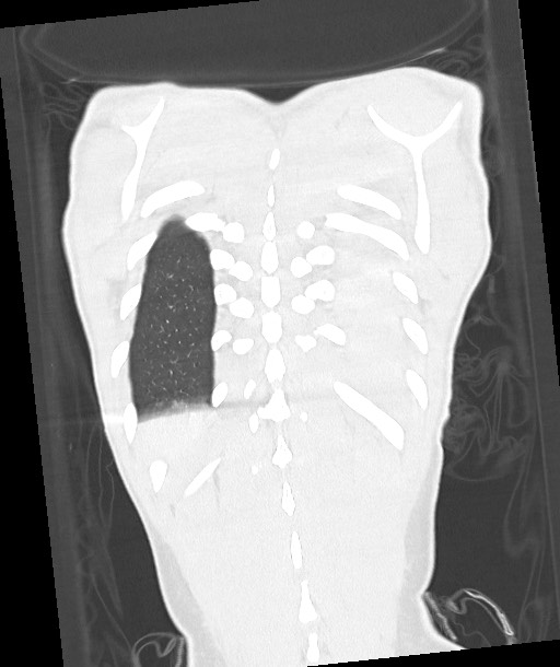 Arrow injury to the chest (Radiopaedia 85367-100975 Coronal lung window 113).jpg