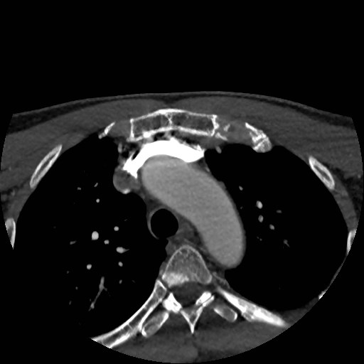 Artery of Percheron infarct (Radiopaedia 48088-52894 A 4).jpg