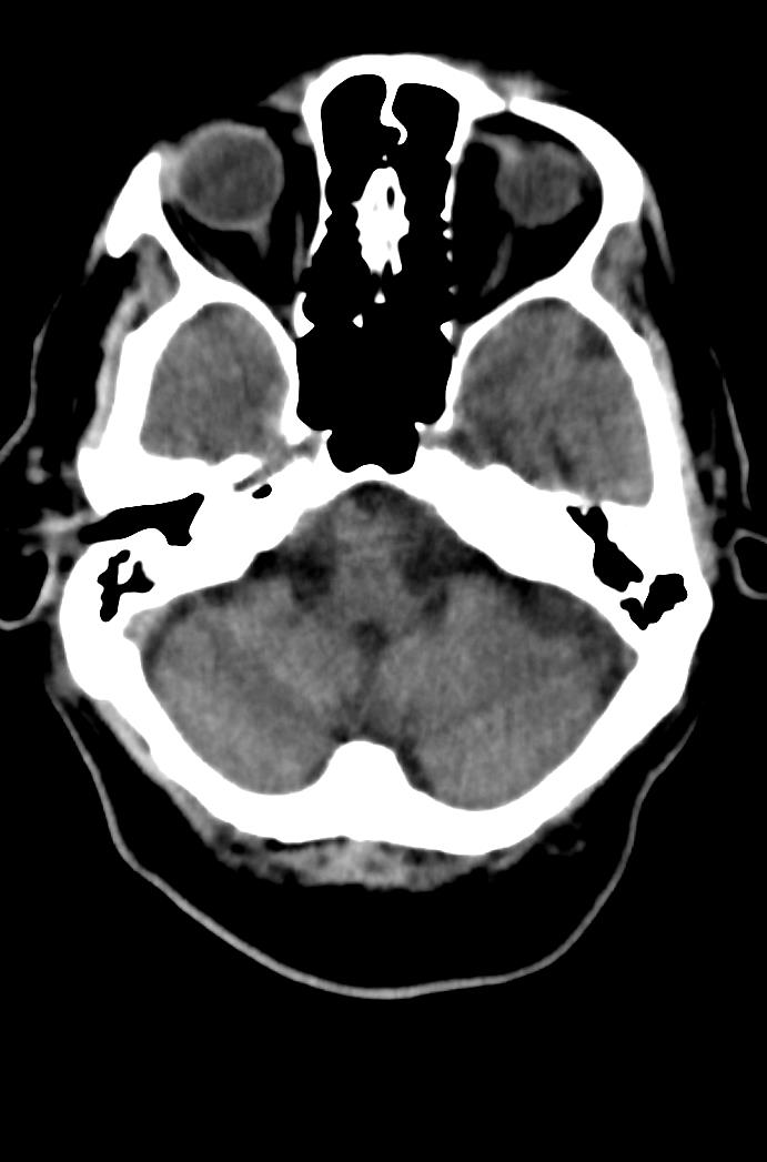 Artery of Percheron infarction (Radiopaedia 80613-94202 Axial non-contrast 49).jpg