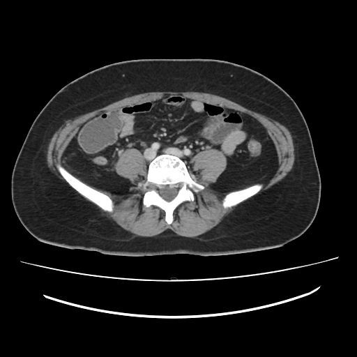 File:Ascending retrocecal appendicitis with liver abscesses (Radiopaedia 60066-67615 B 60).jpg