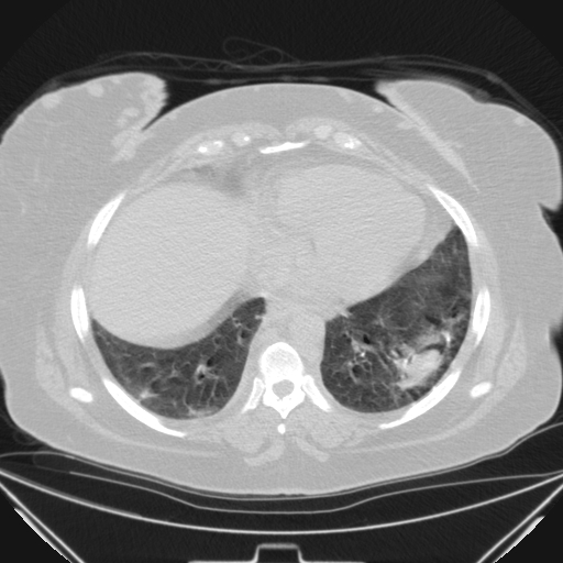Aspergilloma (Radiopaedia 39611-41932 Axial lung window 96).jpg