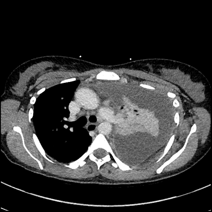 Aspiration pneumonia complicated by empyema (Radiopaedia 73024-83767 B 120).jpg